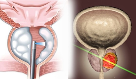 Prostat Tedavisinde Lazer Yöntemleri: HoLEP vs. ThuLEP