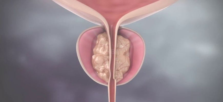 Prostat Embolizasyonu