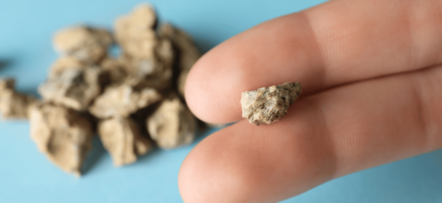 böbrek taşının tekrar oluşumu