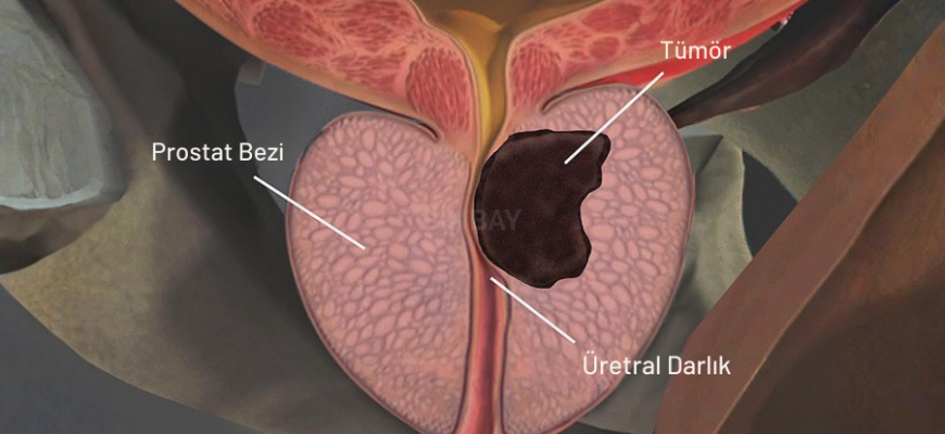 prostat kanseri nedir