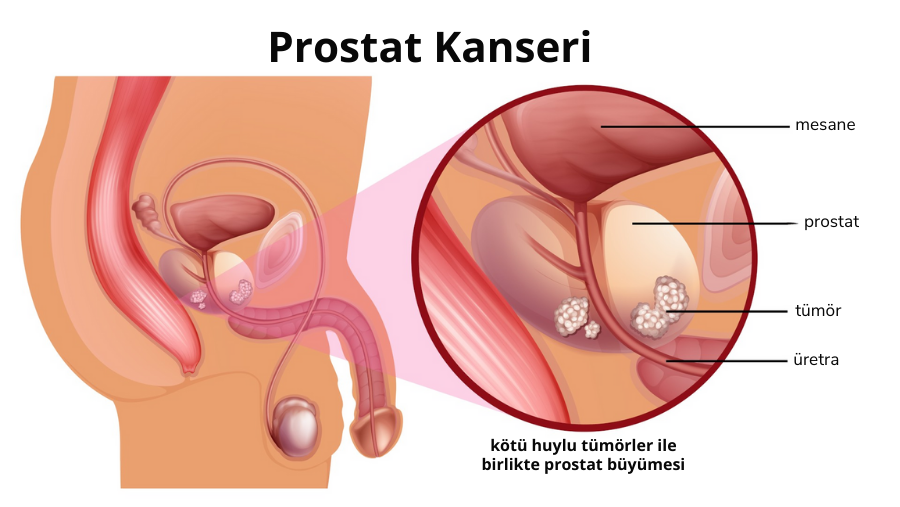 prostat kanseri grafik